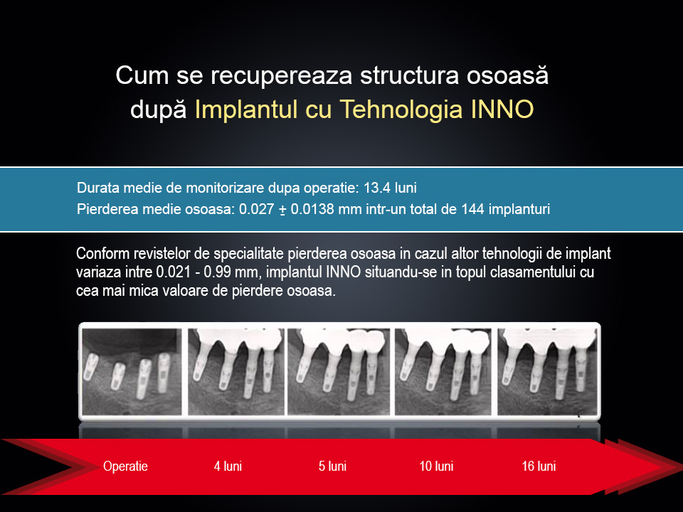 Grafic cu radiografii cu implant dentar INNO si pierderea osoasa cu cea mai mica valoare pe o perioada de 16 luni