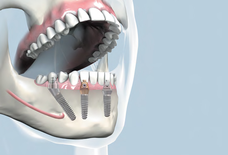 Grafica cu mandibula cu 3 implanturi dentare Bredent Fast and Fixed