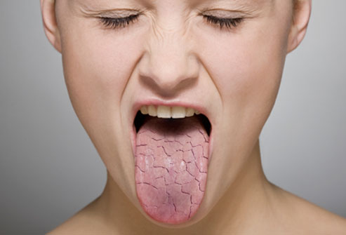 Femeie cu gura uscata si limba crapata