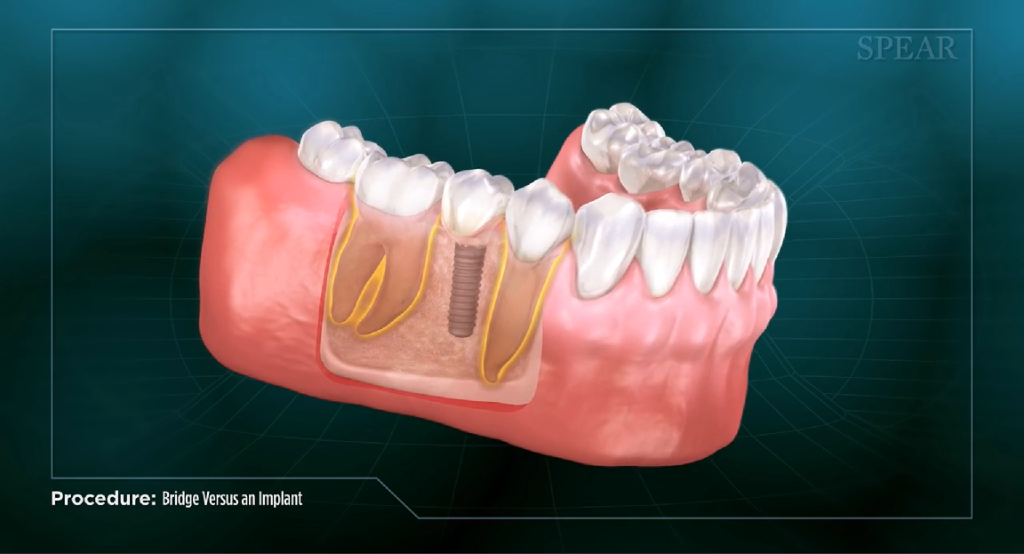 Reprezentare grafica a maxilarului in care a fost inserat un implant dentar