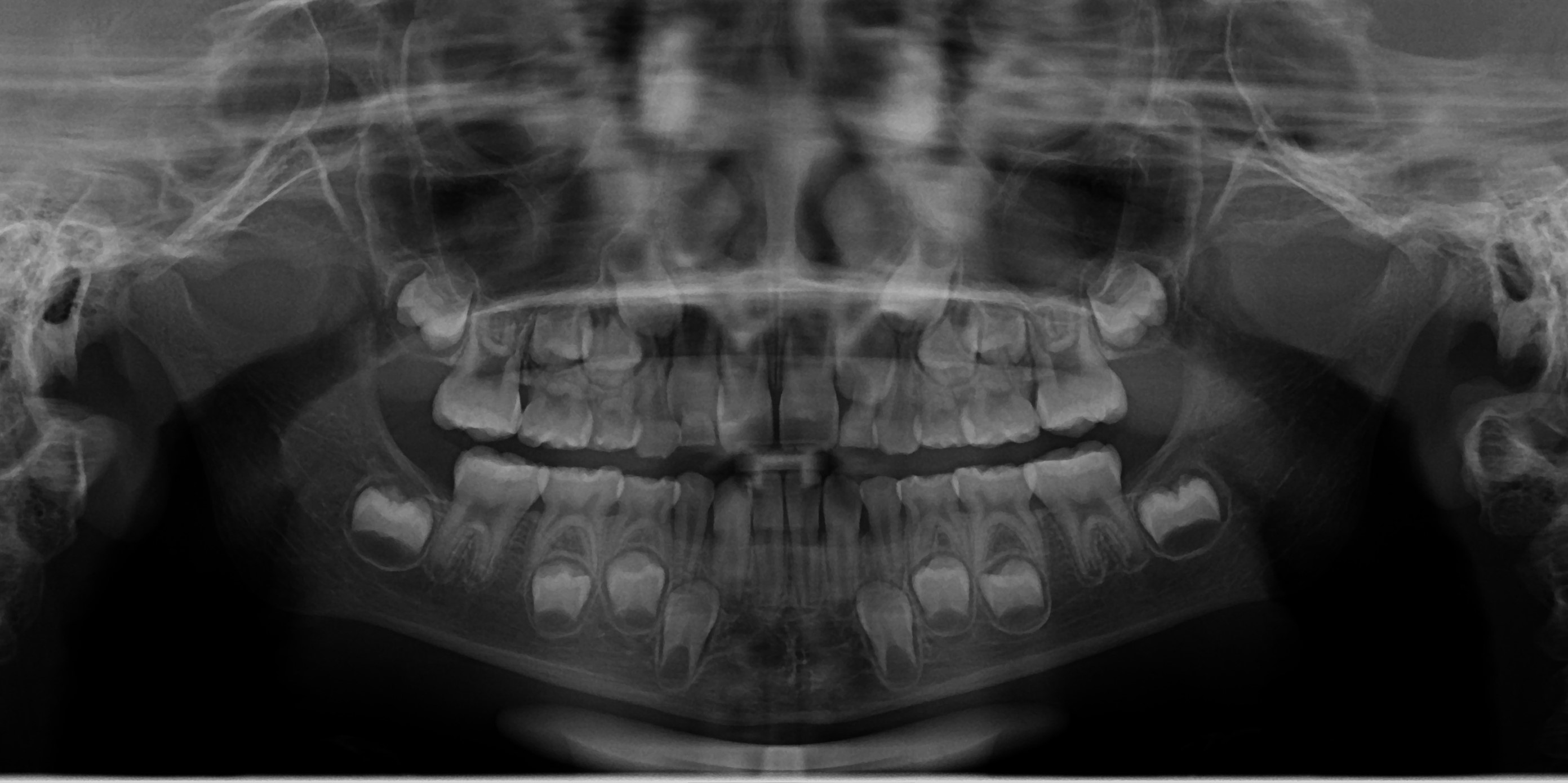 Radiografie cu dintii de lapte ai unui copil