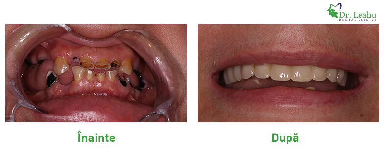 Persoana cu probleme dentare, cu dantura refacuta cu implanturi dentare Bredent - foto inainte si dupa