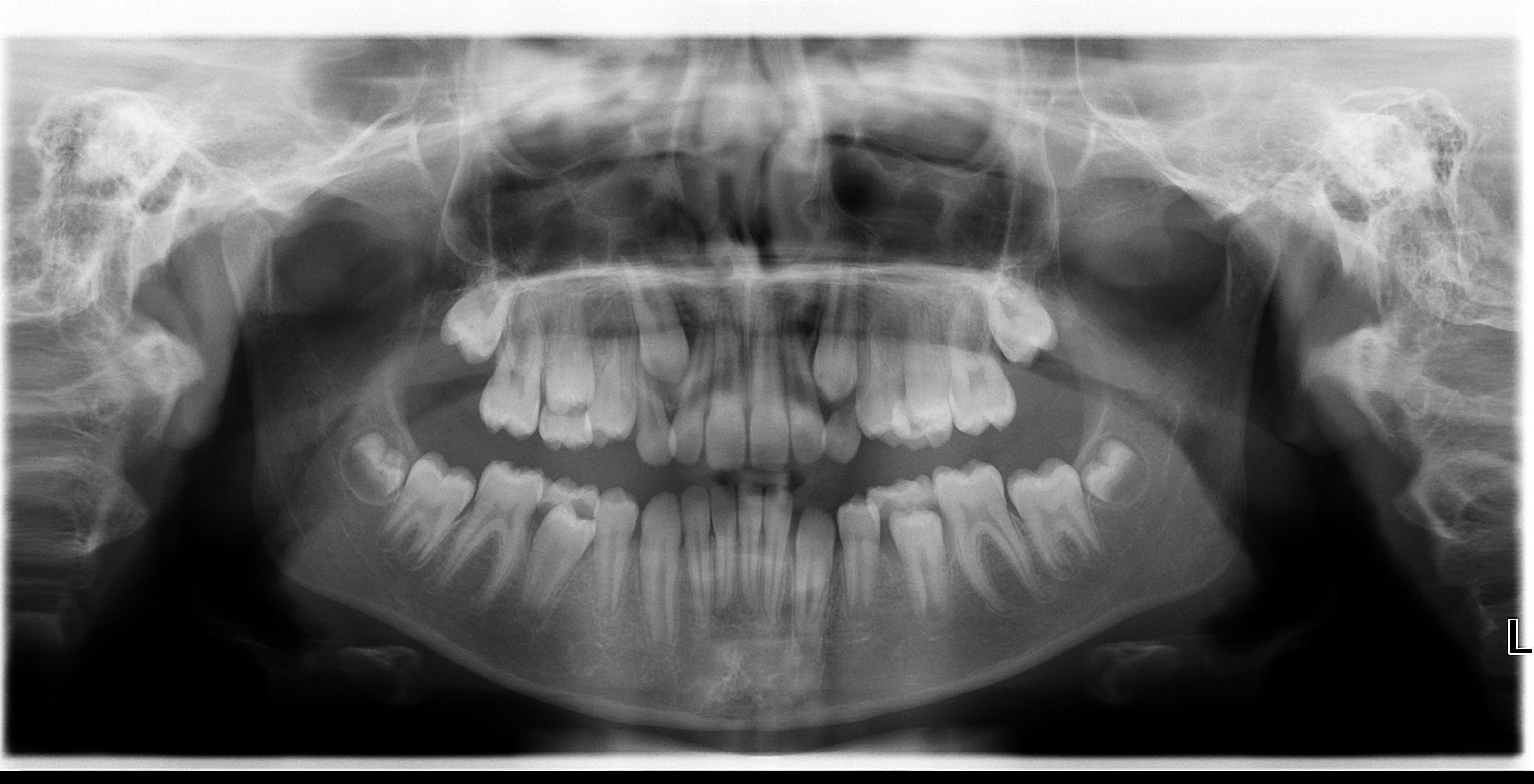 radiografie dentara copii 
