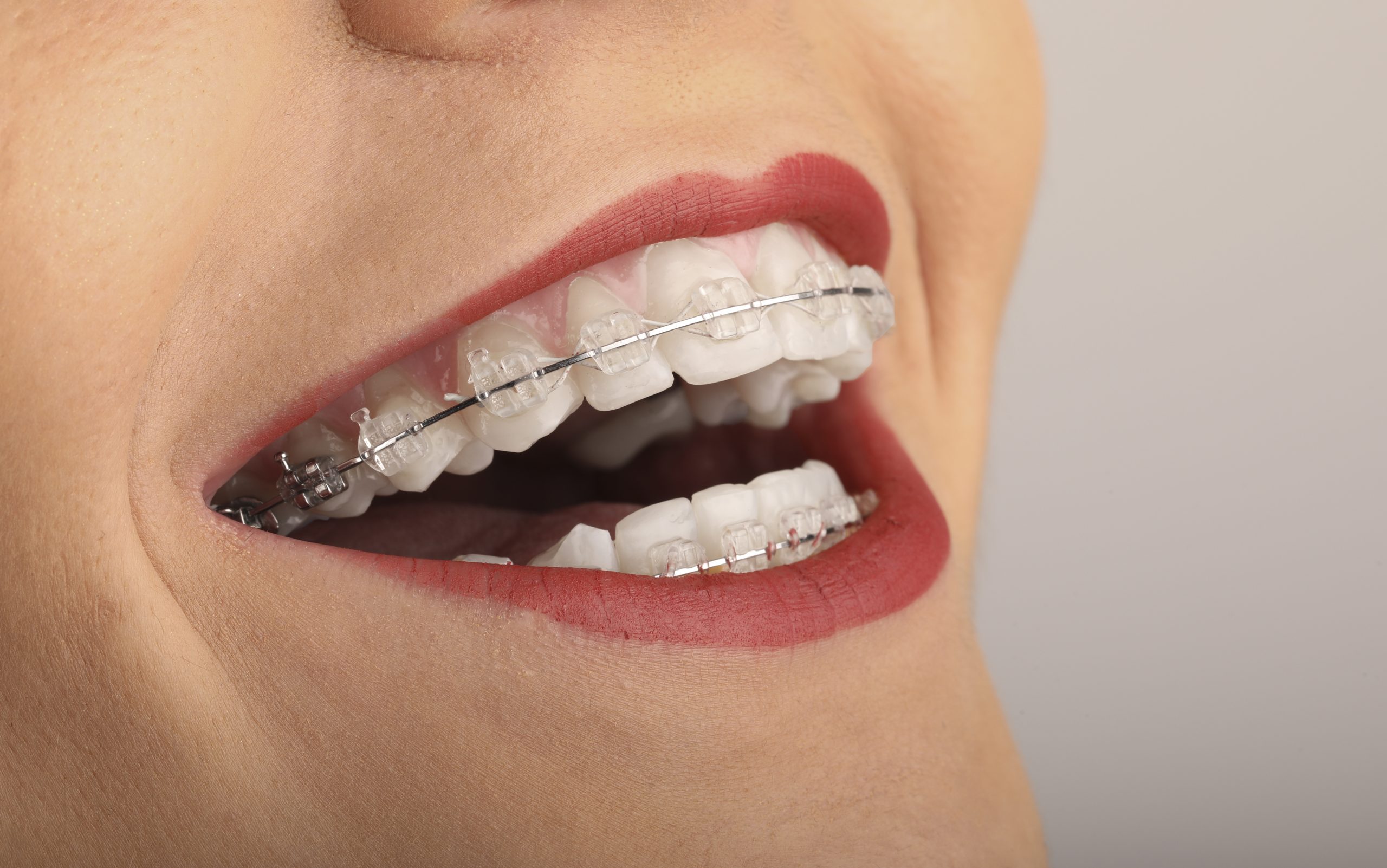 for example plot Armory Ce alimente sunt interzise în timpul purtării unui aparat dentar? -  Clinicile Dentare Dr. Leahu
