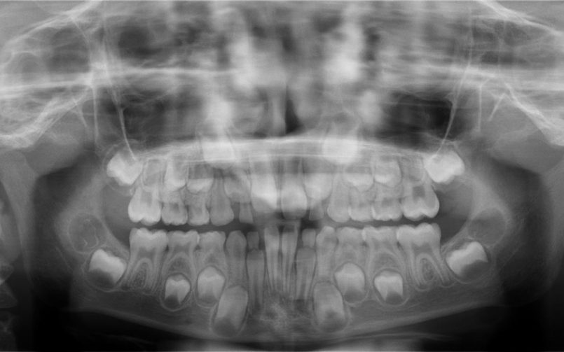 radiografie dentara la copii pentru investigare anodontie la copii